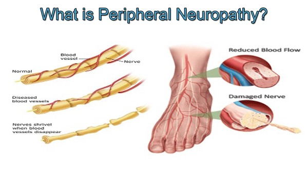 Peripheral Neuropathy