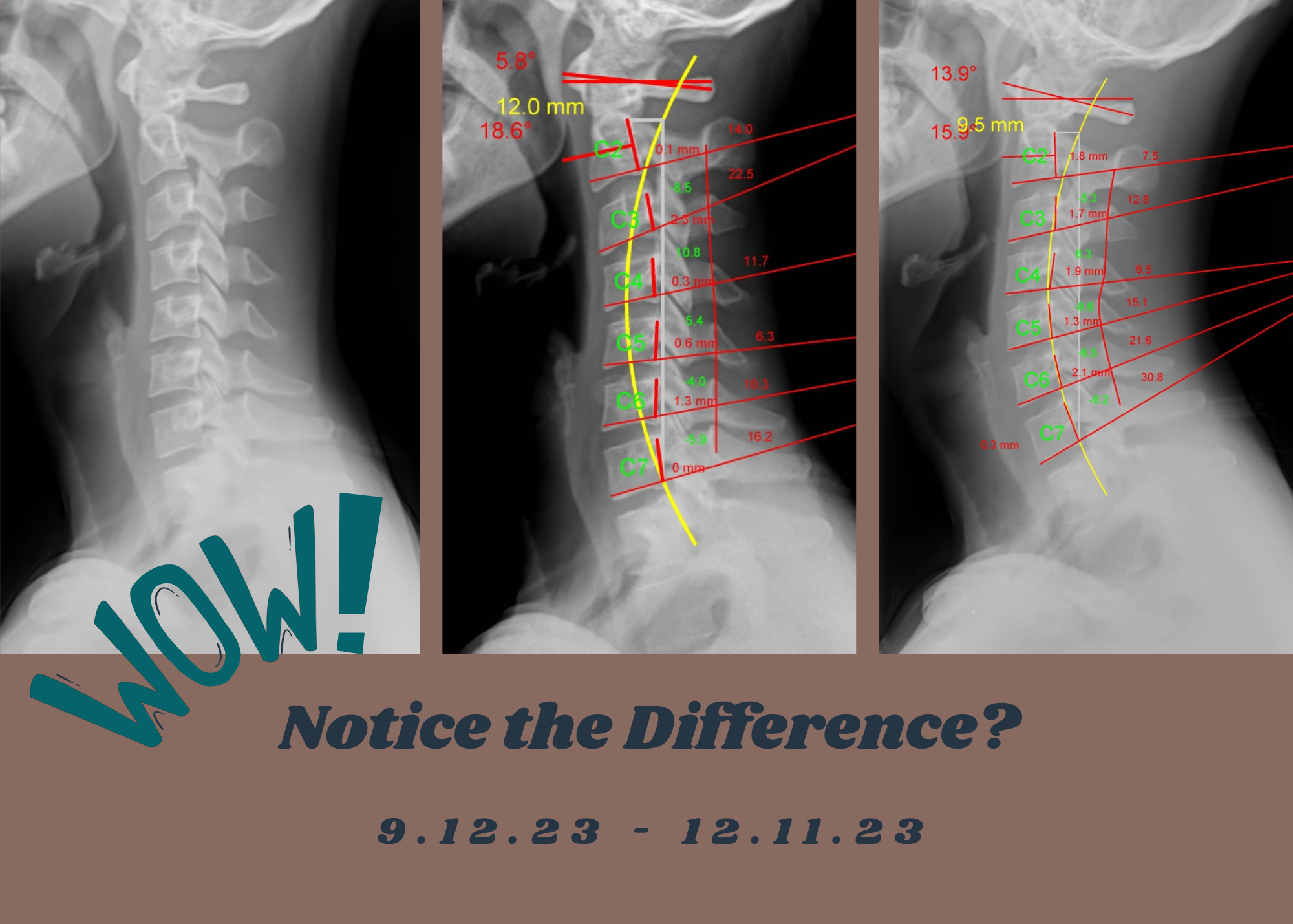 Spinal Correction Fargo Chiropractic